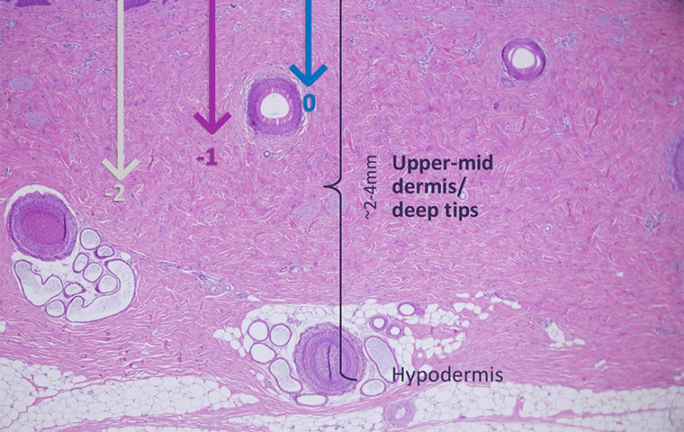 Skin Lifting & Remodeling- Everything You Need To Know