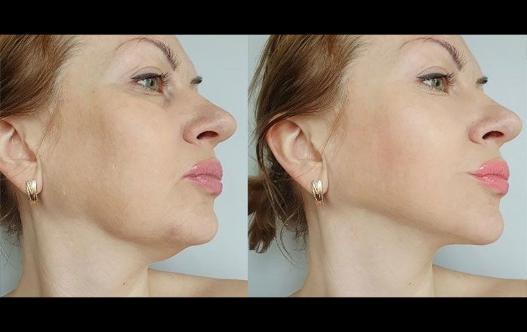 What Is a Polydioxanone (PDO) Thread Lift?